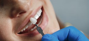 Veneers - A Solution for Smile Imperfections