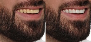 Transform Your Smile with Teeth Whitening