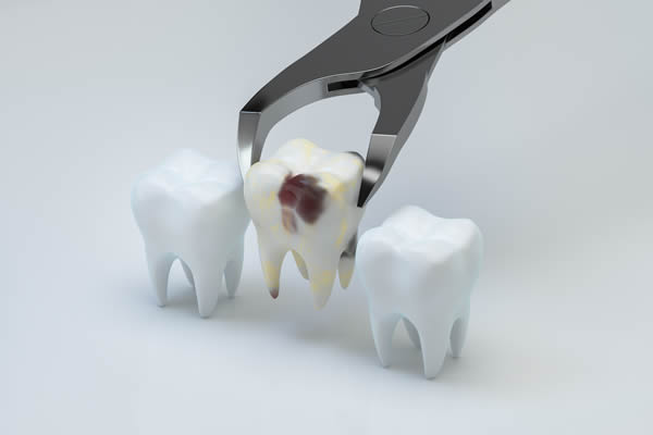 Teeth Extraction Teeth Extraction
