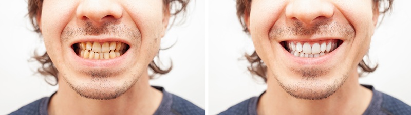 teeth whitening